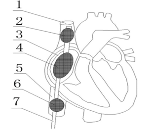 静脉心脏辅助装置